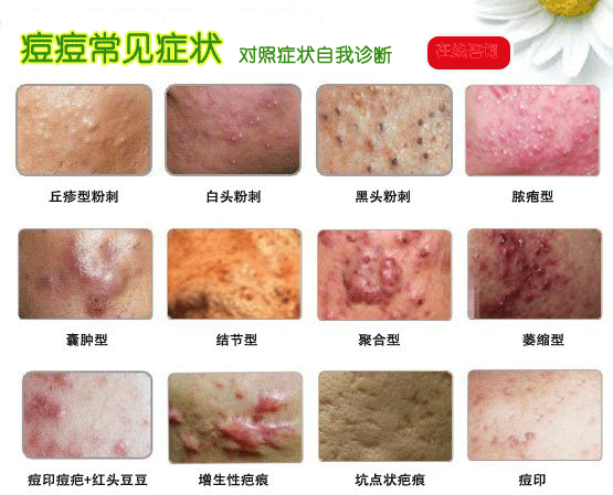 海口看青春痘的医院