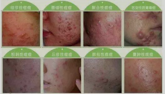 痤疮与青春痘治疗的方法-海口治疗痤疮医院