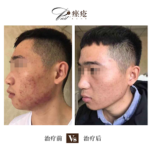 皮肤长痘之后医生不建议做的五件事