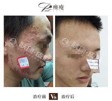 毛囊炎属于青春痘吗,具体临床症状是什么?